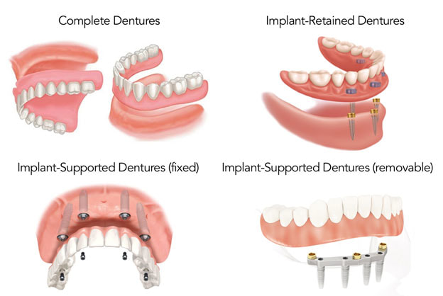 Overdenture Vs Implant Supported Denture Sexiezpix Web Porn 