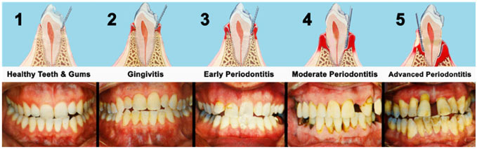 Common Causes for Bleeding Gums & Treatment