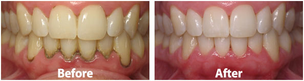 Scaling Polishing